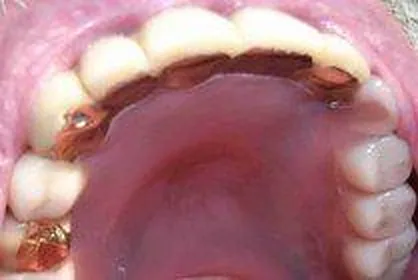 2. Fall 2014: Implantate im Seitenzahnbereich - Die Ausgangssituation