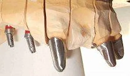 2. Fall 2013 - Implantataufbauten und Innen-Konuskronen