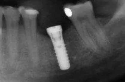 Röntgenbild eines Implantats mit Heilkappe zwischen natürlichen Zahnwurzeln
