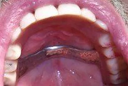 2. Fall 2014: So sieht die neue Vollprothese im Mund aus