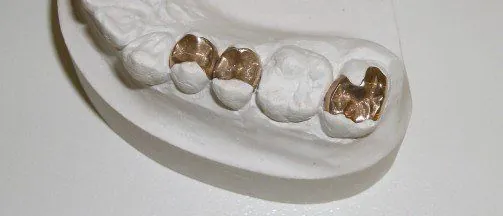 Gegossene Goldinlays auf einem Gipsmodell