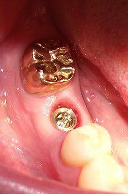 Implantat mit Heilkappe zwischen Goldkrone und Kompositfüllung