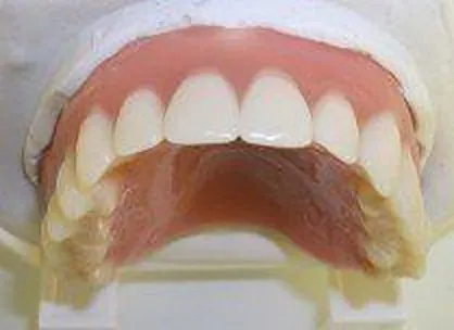 Vollprothese auf dem Gipsmodell