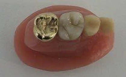 Zahnersatz mit Goldkrone und Keramikkronen auf dem Modell