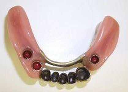 1. Fall 2013: Implantate im Seitenzahnbereich - Druckknopfverankerung