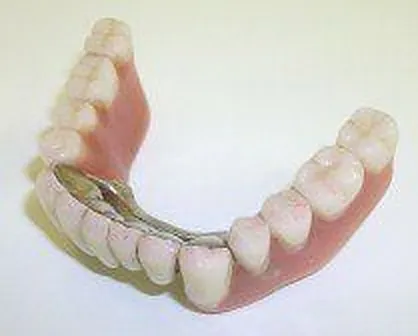 1. Fall 2013: Implantate im Seitenzahnbereich - nicht sichtbare Verankerung