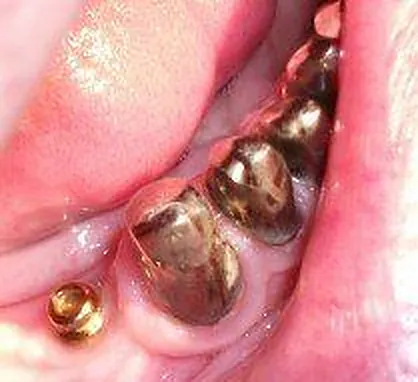 1. Fall 2013: Implantate im Seitenzahnbereich - Druckknopfsystem
