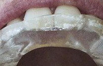 Transparente ok schiene